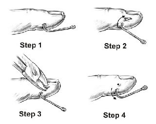 4 Ways to Remove a Fishhook from Skin - wikiHow Health